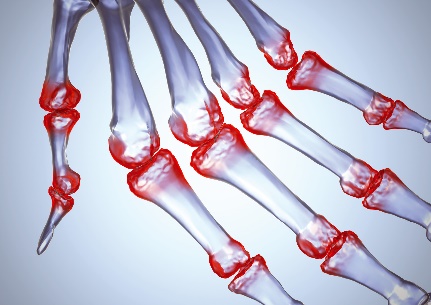 kaip sustabdyti artrita tratamentul salin al artrozei